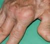 Rheumatoid arthritis (RA)