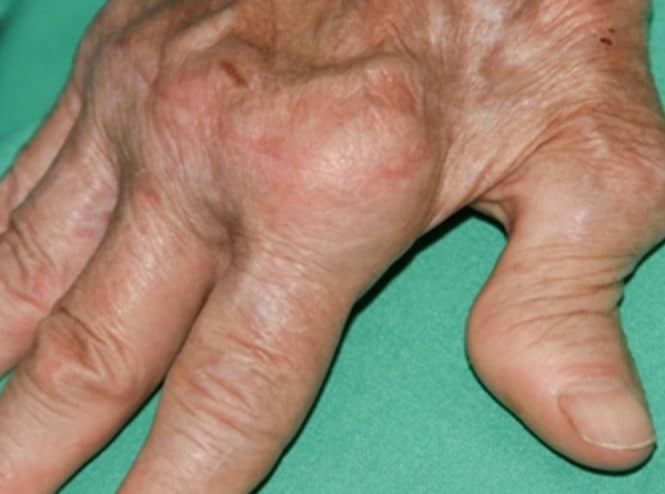 Rheumatoid arthritis (RA)