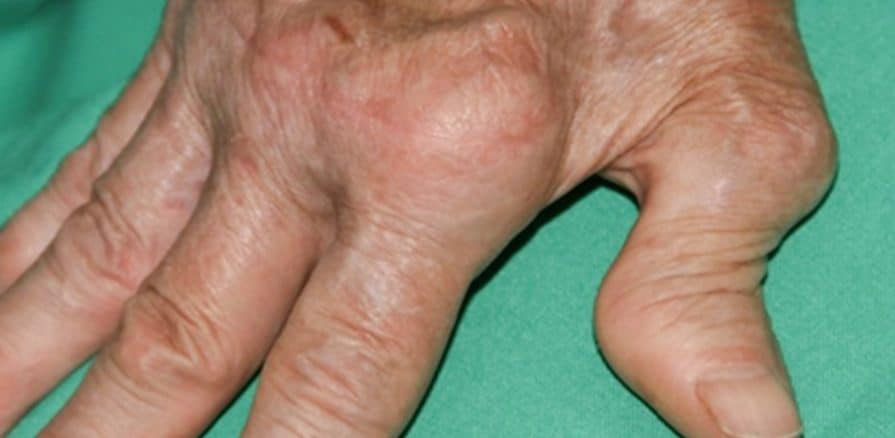 Rheumatoid arthritis (RA)