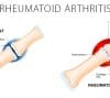 Rheumatoid Arthritis