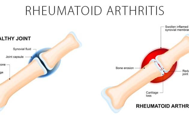 Rheumatoid Arthritis