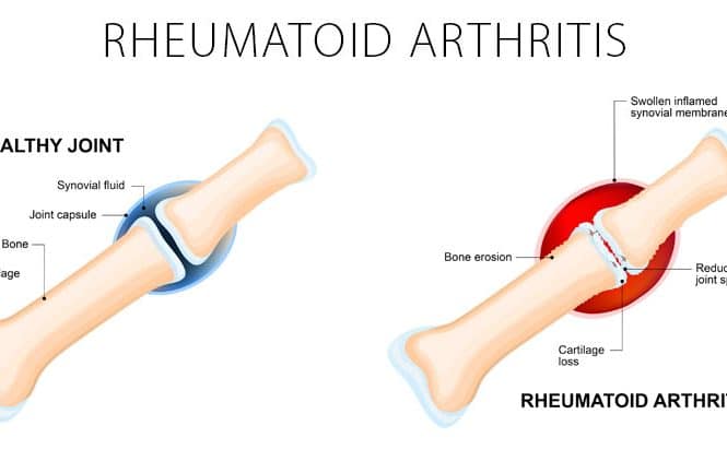 Rheumatoid Arthritis