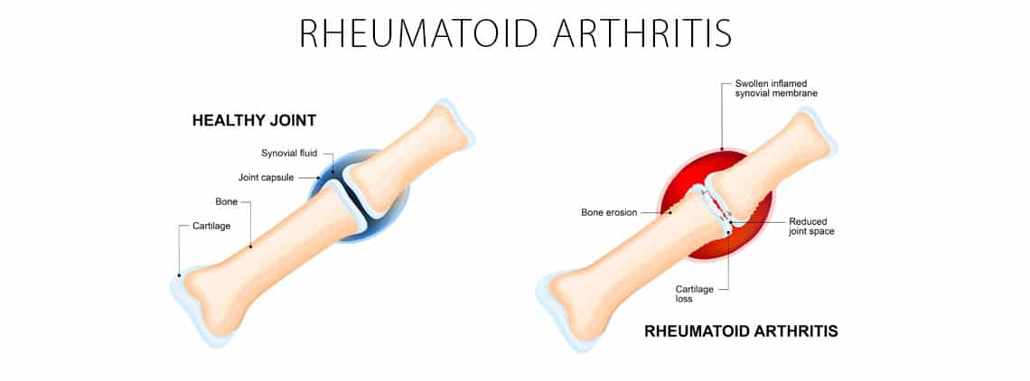 Rheumatoid Arthritis